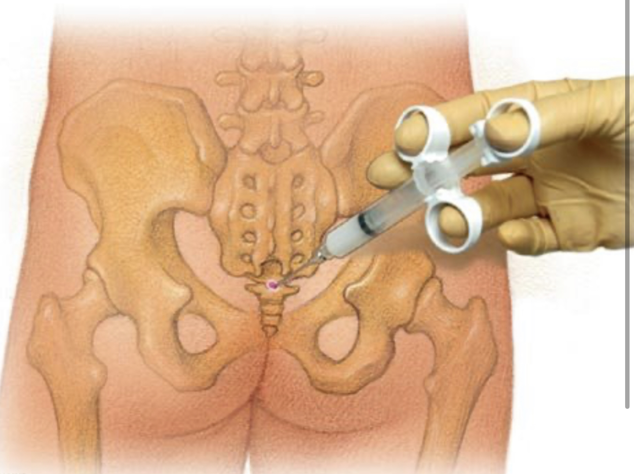 Sacrococcygeal joint and ligament Injection
                                                          