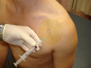 Shoulder Intraarticular Joint Injection
                                                          