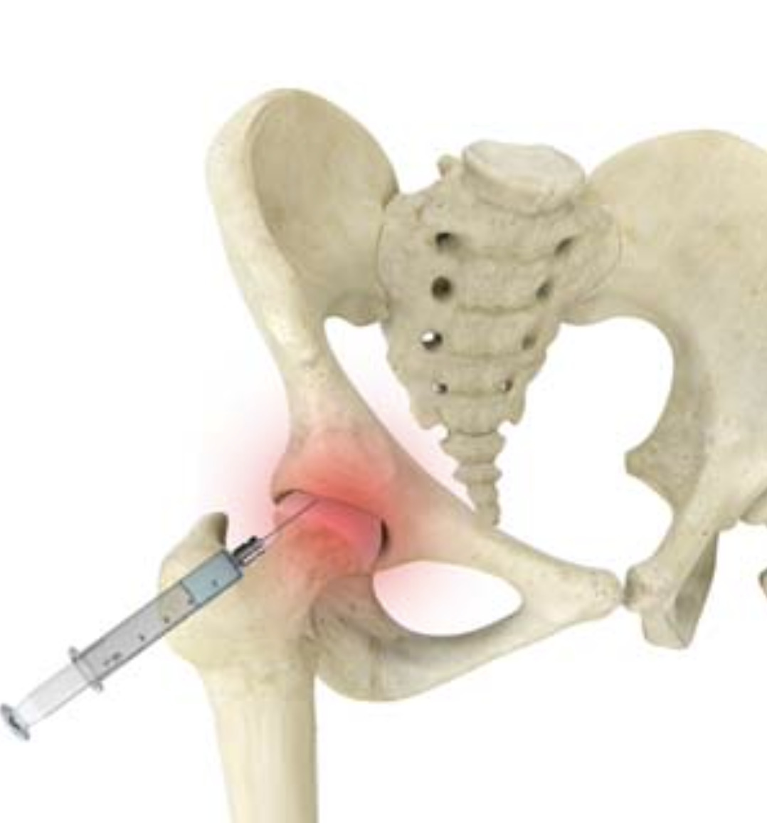Hip Injection and Hip Nerve Block
                                                          