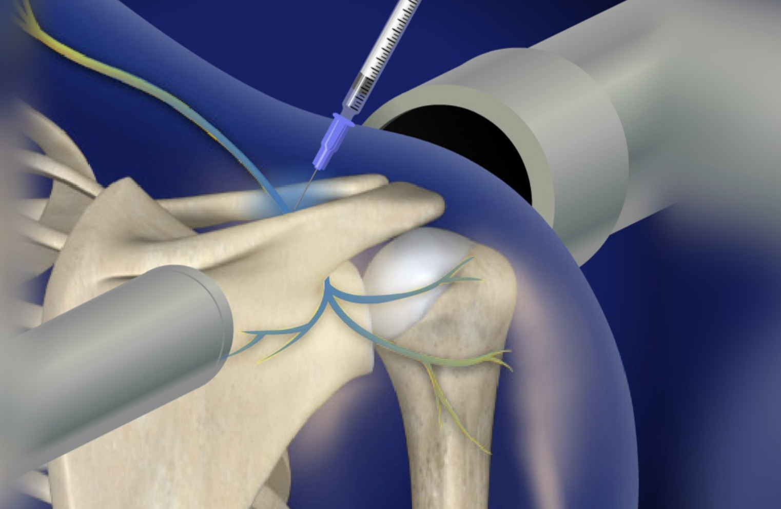 Suprascapular Nerve Block and Radiofrequency Ablation
                                                          